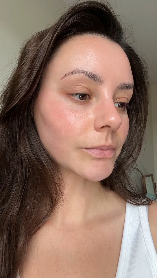 The Beauty Editor’s Curse: How Too Much of a Good Thing Can Lead to Perioral Dermatitis