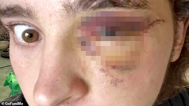 Kaden Rummler: 'Completely Blind' in Left Eye After Projectile Strike During ICE Protest Clash in Santa Ana