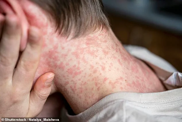 Emergency Lockdown at ICE Detention Center Sparks Public Health Concerns Over Measles Outbreak