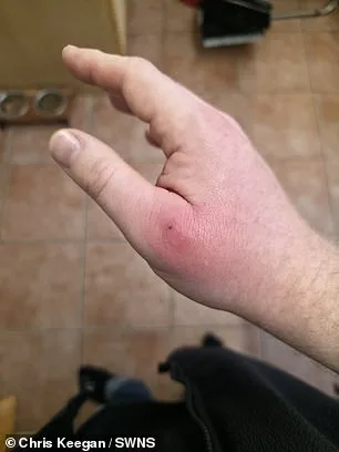 Coventry Man's Spider Bite Infection Sparks Concerns Over False Widow Spread in UK